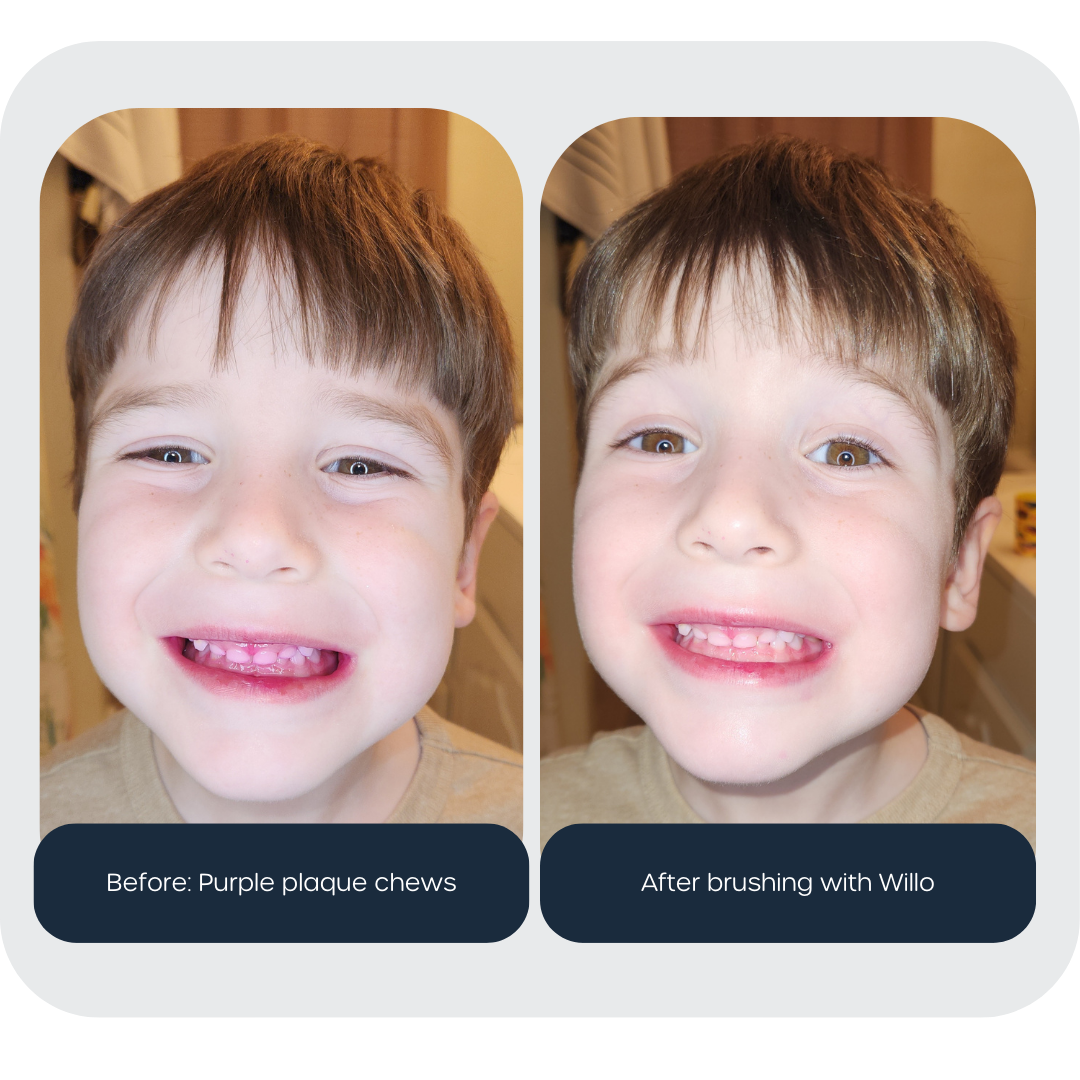Comparison image of a boy with plaque disclosing tablet before and after brushing with Willo