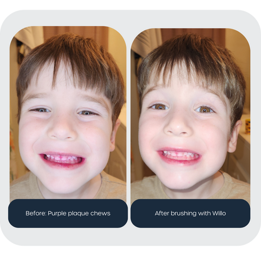 Comparison image of a boy with plaque disclosing tablet before and after brushing with Willo