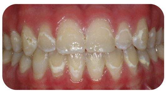 What Happens If Kids Don't Brush Properly With Braces?
