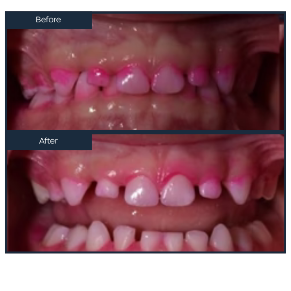 A close-up dental comparison image showing "Before" and "After" views of a child's teeth using a pink plaque disclosing solution. The top "Before" image displays prominent pink plaque accumulation along the gumline, while the bottom "After" image shows clean teeth with significantly reduced plaque coverage following a brushing cycle.