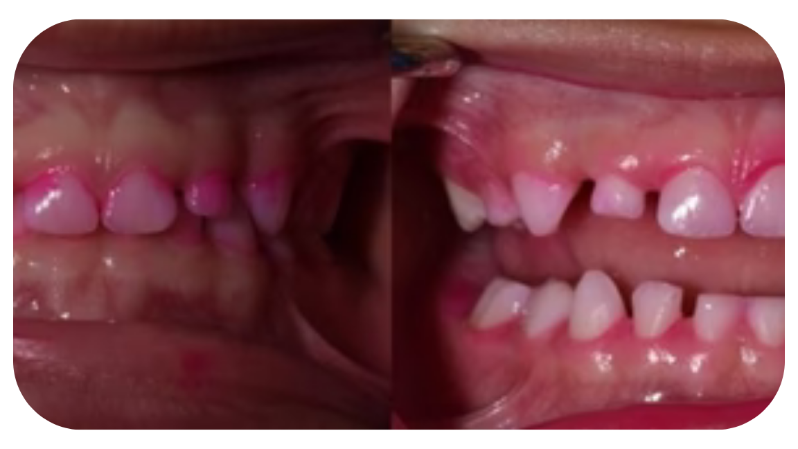 Before and after comparison of teeth brushed with Willo automatic toothbrush