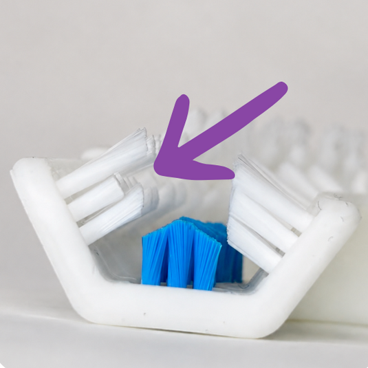 purple arrow pointing to bristles angled around brackets for ortho brush head