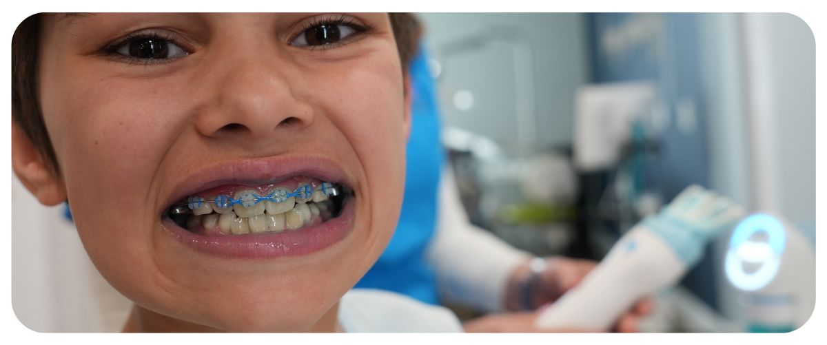 Extreme close-up of a young boy smiling to show his dental braces with blue bands, while a U-shaped smart toothbrush is held in the background background.