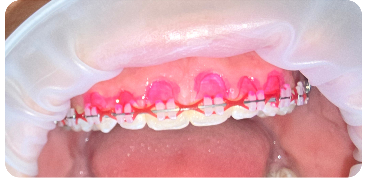 Macro view of upper teeth with braces, showing pink plaque disclosing solution highlighting biofilm accumulation along the gumline.