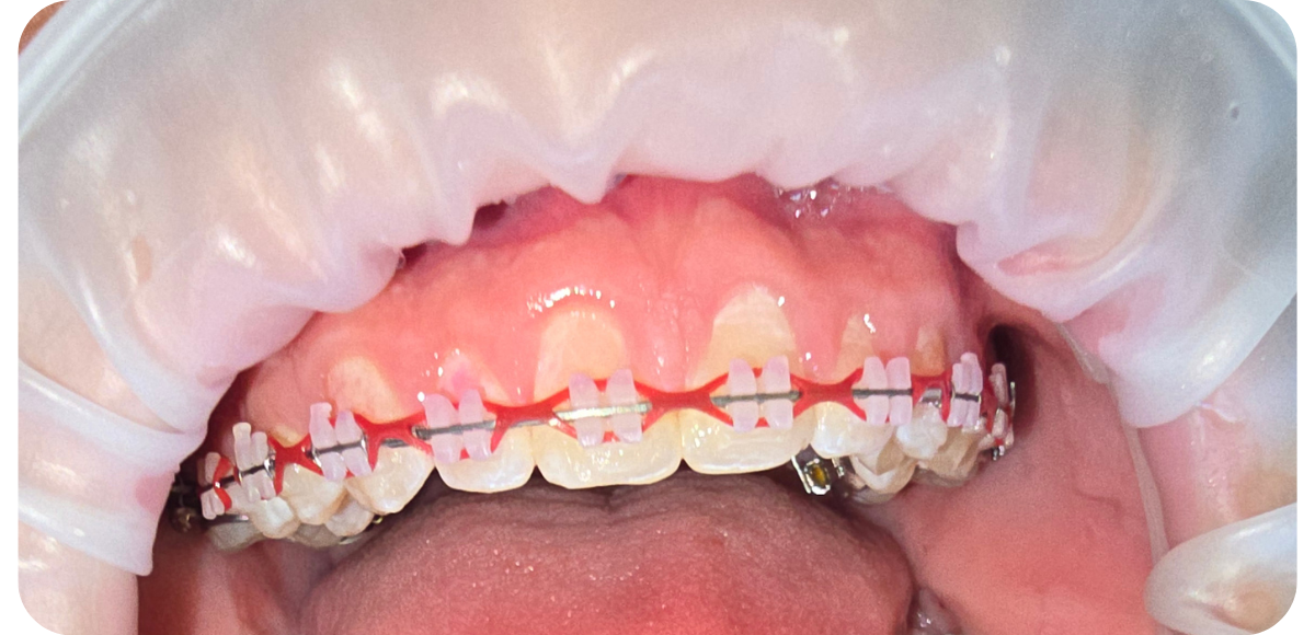 Close-up macro view of upper teeth with orthodontic ceramic brackets, a silver archwire, and a red elastic power chain band.