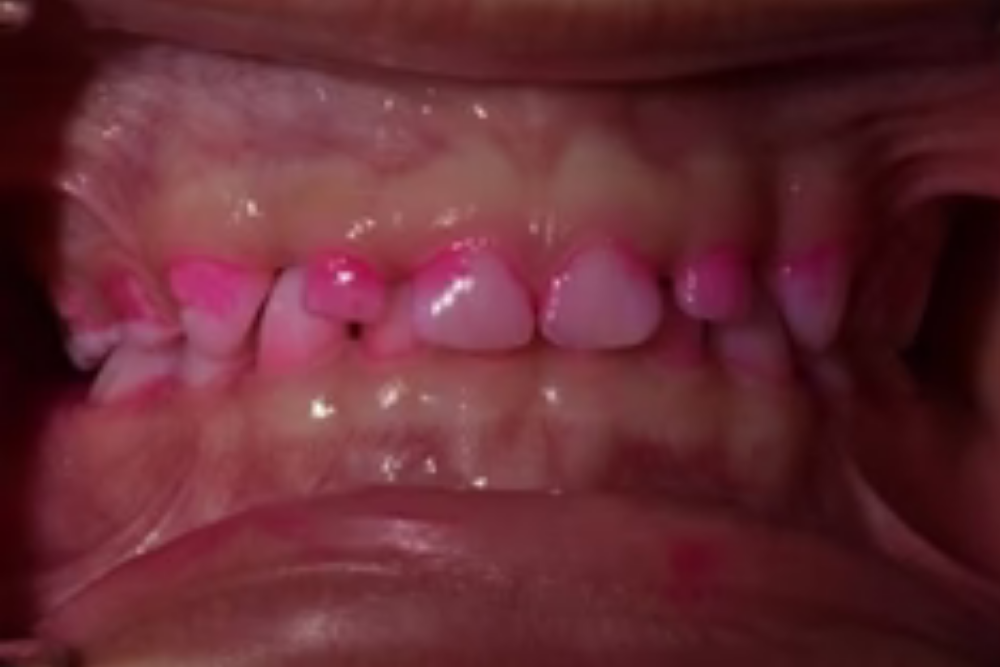 close up of pink plaque disclosing agent on teeth after brushing with regular toothbrush