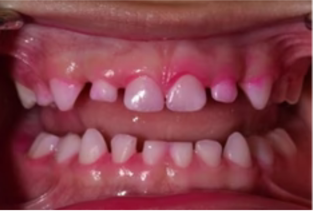 close up of pink plaque disclosing agent after brushing with Willo