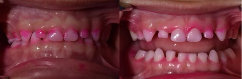Before and after comparison of teeth with pinkish discoloration.