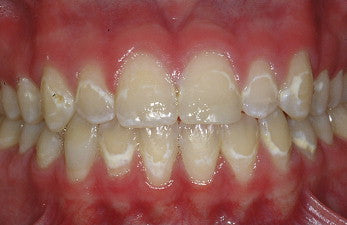 Close up of white spot lesions on teeth after braces were removed