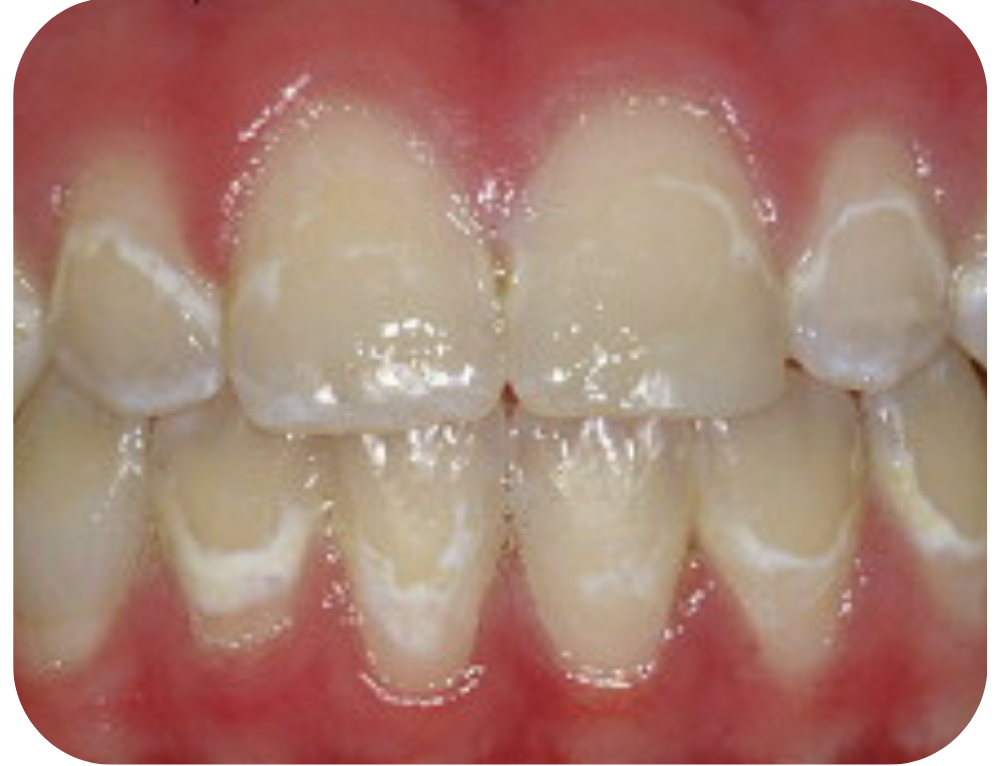 Close-up of a person's teeth and gums, showing white spot lesions after braces removed
